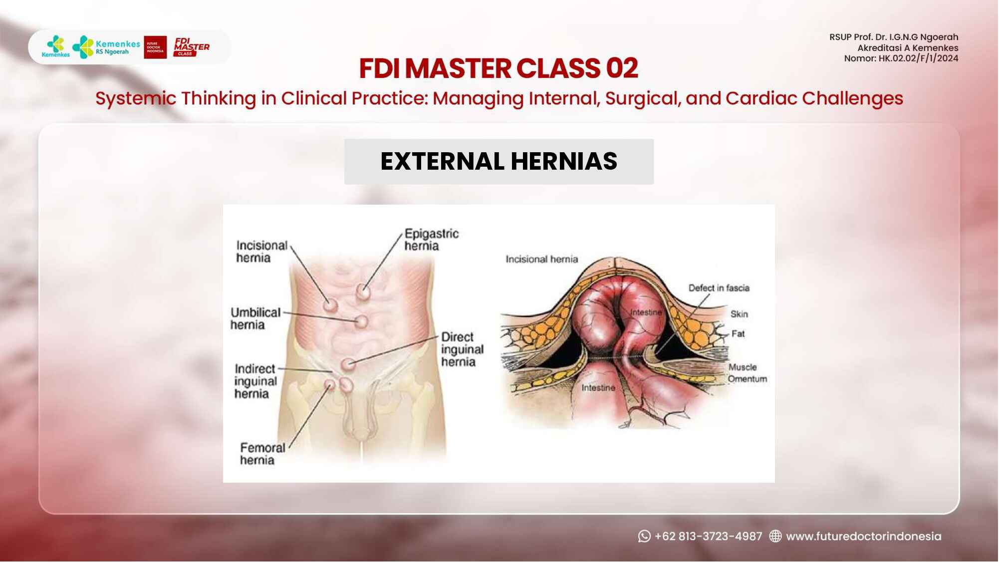 hernias-demystified--types-diagnosis-and-management-principles-448