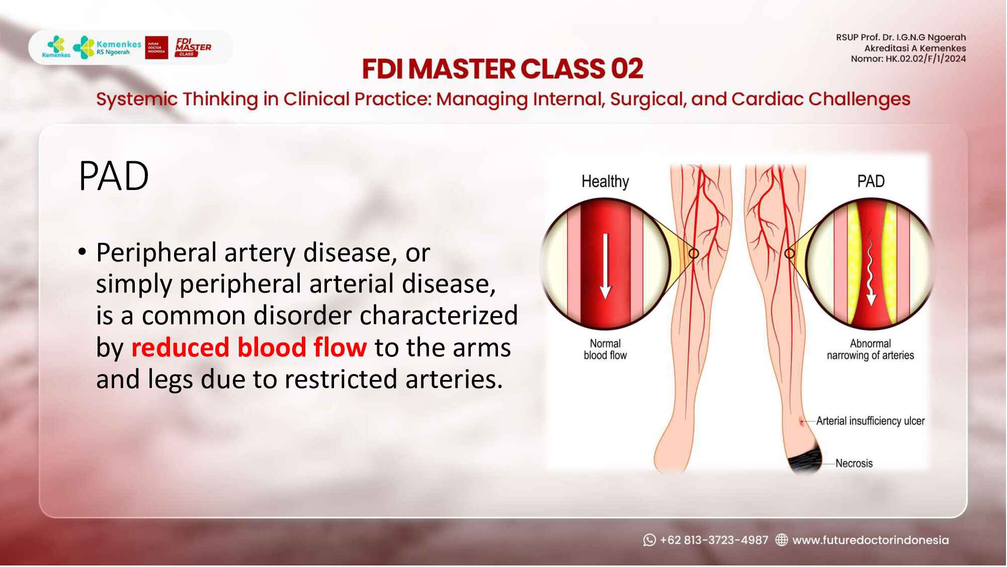 peripheral-arterial-disease-(pad)_-the-overlooked-link-in-chronic-care-213