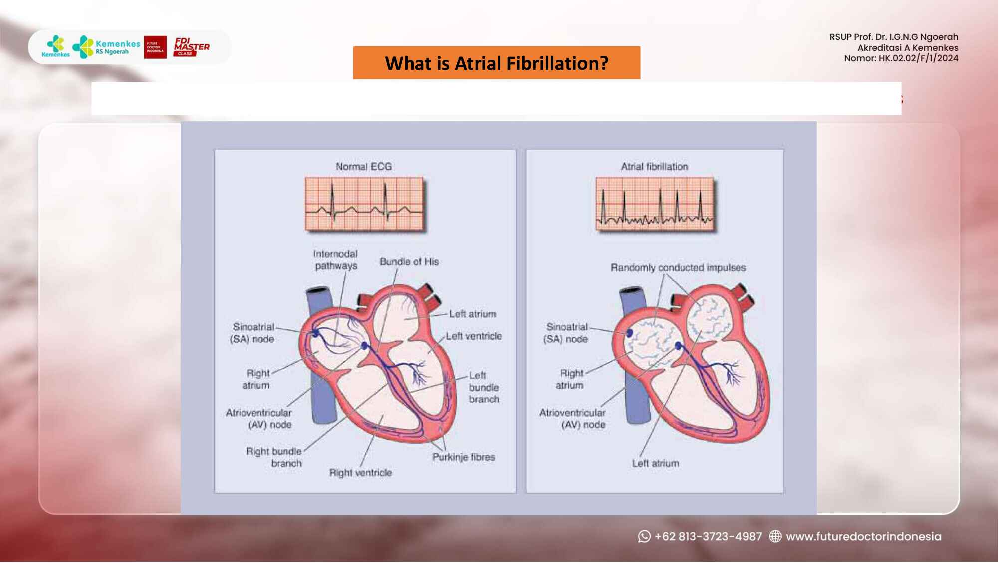 understanding-atrial-fibrillation-and-common-arrhythmias-153